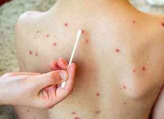 Measles Case Confirmed in Dublin Airport Bus Passenger: HSE Issues Alert news-22082024-185541