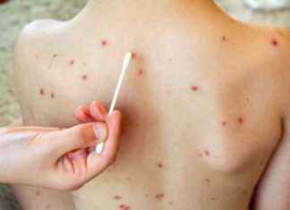 Rise in Measles Cases: 112 Cases Reported, Up from 4 Last Year news-17092024-014705