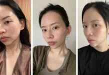 Achieving Brighter and Smoother Skin with Salmon Sperm Injections news-31102024-073203