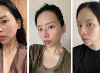 Achieving Brighter and Smoother Skin with Salmon Sperm Injections news-31102024-073203